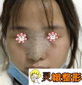 郑东学鼻子案例图_隆鼻案例照片