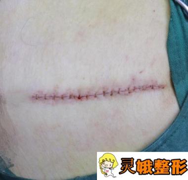 赣州市人民医院整形科疤痕修复