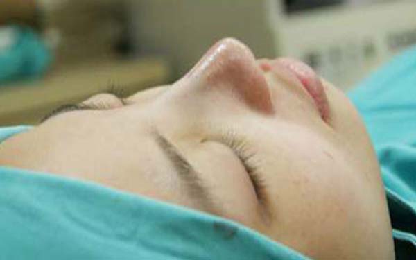 韩国纯真医院Mesh隆鼻手术，拥有美丽的鼻子