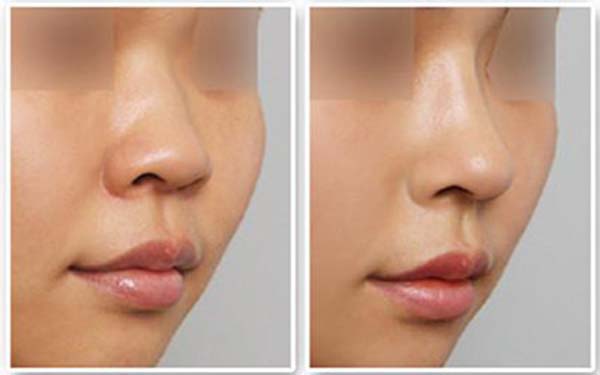 韩国纯真医院Mesh隆鼻手术，拥有美丽的鼻子