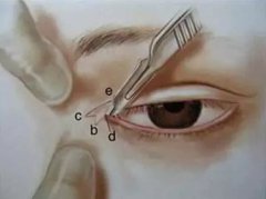 眼部手术手术一般多少钱？眼部整形手术过程~