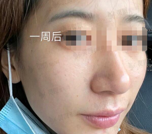 湘潭市中心医院医疗美容科激光祛斑后一周