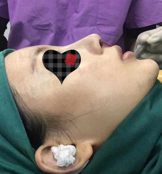 硅胶+耳软骨隆鼻手术过程