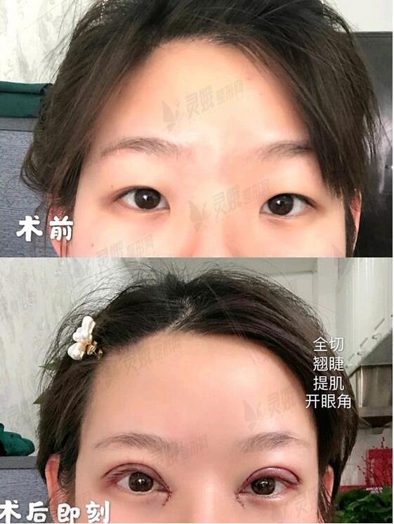 台州中心医院整形科陶革方双眼皮怎么样？双眼皮果“眼见为实”