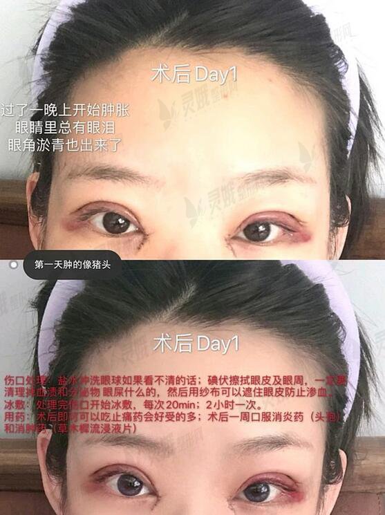 台州中心医院整形科陶革方双眼皮怎么样？双眼皮果“眼见为实”