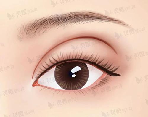 双眼皮手术术后有什么副作用吗?