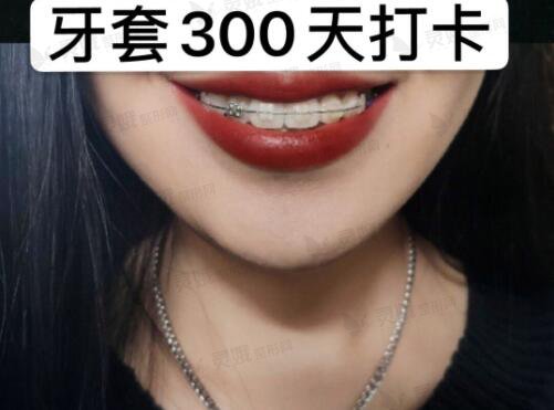 青岛交通医院口腔科牙齿整形后300天