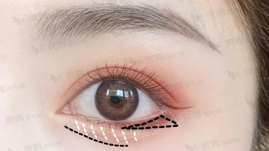 眼部综合手术的开眼角手术方式有什么?开外眼角