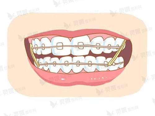牙齿矫正手术有什么术后注意事项?