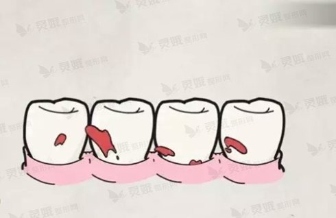 牙齿矫正手术有什么后遗症或副作用吗?