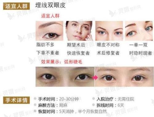哪种双眼皮手术方式比较好?