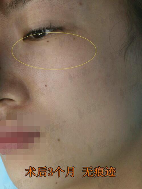 协和医院冯晓玲医生割眼袋后3个月