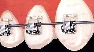 做牙齿矫正的误区