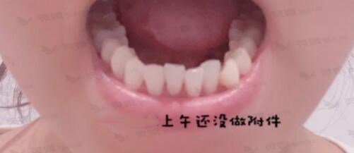 青海省中医院牙科牙齿矫正前