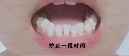 青海省中医院牙科牙齿矫正中