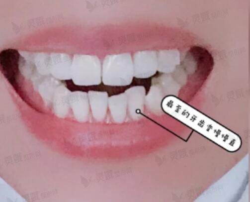 青海省中医院牙科牙齿矫正后果