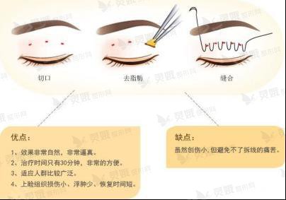 徐州李雪阳对双眼皮手术方式的科普：埋线双眼皮