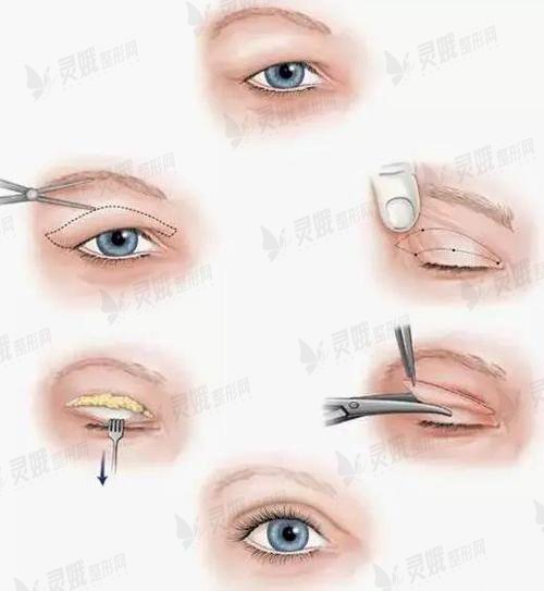 徐州李雪阳对双眼皮手术方式的科普：全切双眼皮