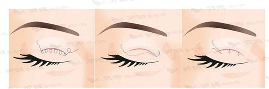 徐州李雪阳对双眼皮手术方式的科普：韩式定点双眼皮