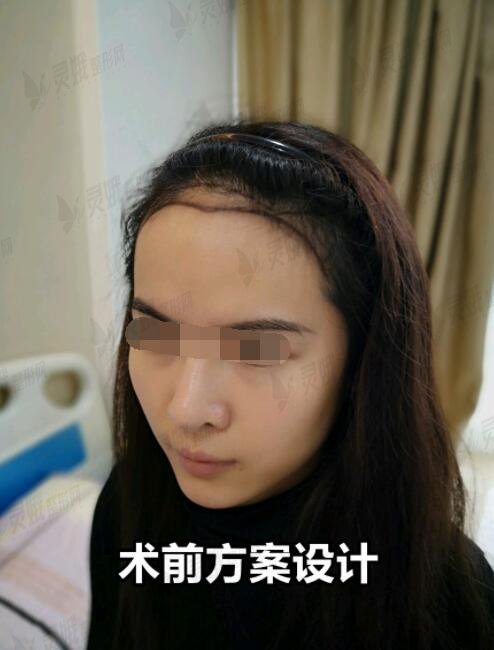 重庆西南医院整形外科王量植发前
