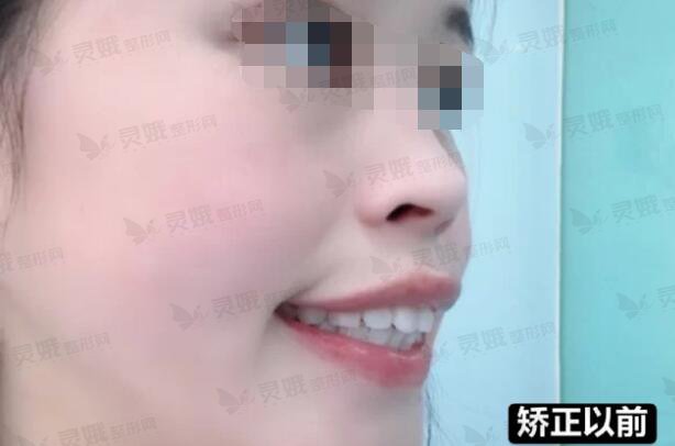甘肃省人民医院口腔内科牙齿整形前