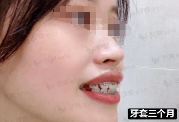 甘肃省人民医院口腔内科牙齿整形后3个月