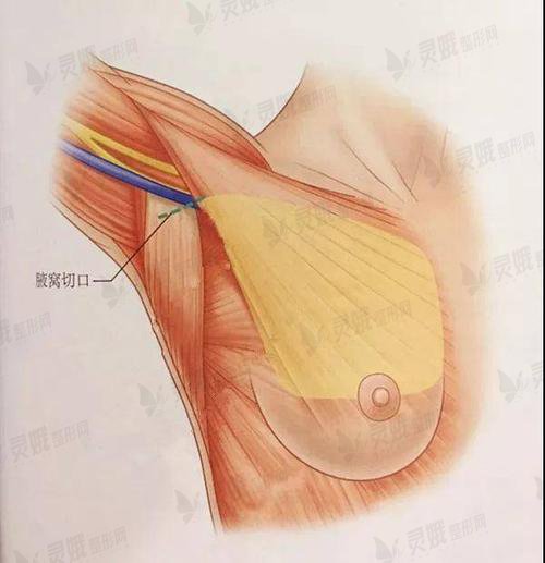 隆胸手术的切口有哪几个地方?