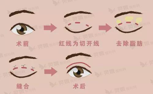 李广帅介绍对于双眼皮术后的注意事项如下：