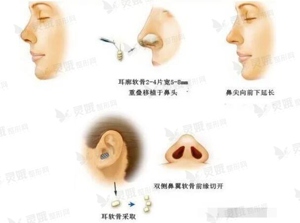耳软骨隆鼻过程