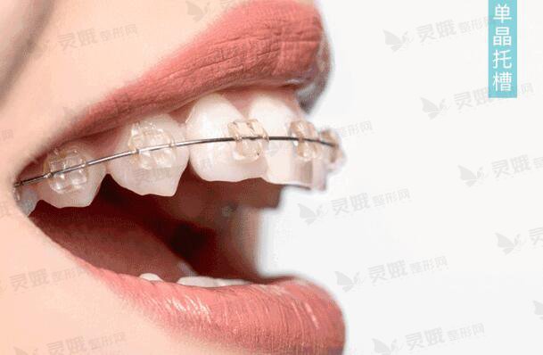 瓷牙和种植牙可以矫正吗
