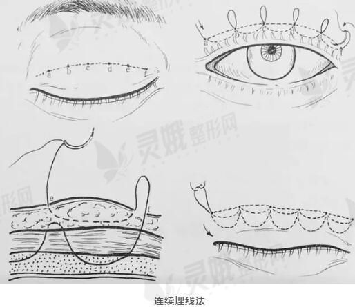 埋線雙眼皮5天恢復圖怎麼樣術前術後案例分享埋線雙眼皮注意事項