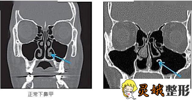 空鼻症十分嚴重嗎有哪些矯治方案